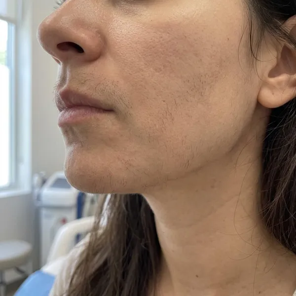 does facial hair grow back after laser hair removal